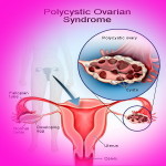 polycystic-ovarian-syndrome450