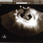 sarah fetus 10 weeks